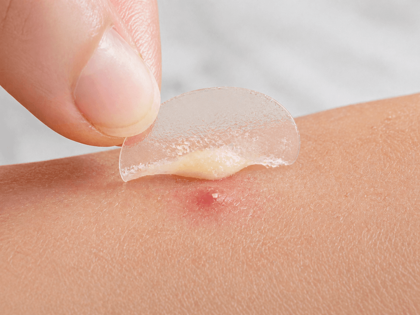A finger applying a clear hydrocolloid patch directly over a small inflamed pimple
